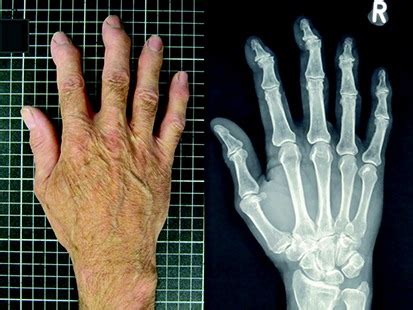 A Patient's Guide to Osteoarthritis of the Hand - Hand and Upper Limb ...