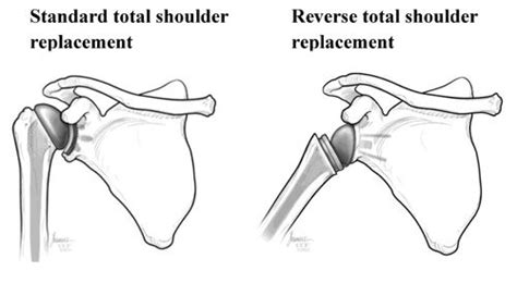 Standard Shoulder Replacement vs. Reverse Shoulder Replacement ...