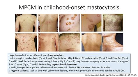 Mastocytosis | PPT