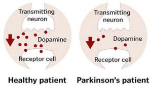 Parkinson’s Disease : Causes, Symptoms And Treatment