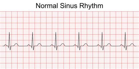 Normal Ecg Reading