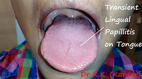 Transient lingual papillitis