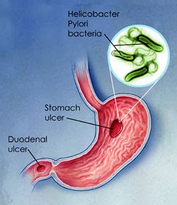 Helicobacter Pylori - United Digestive