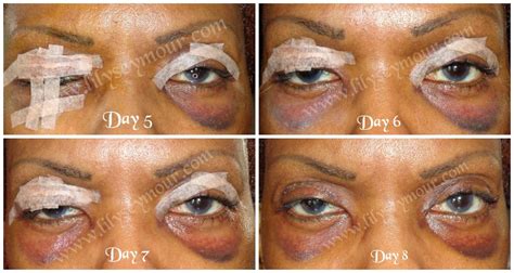 Pin on Blepharoplasty Eyelid Surgery