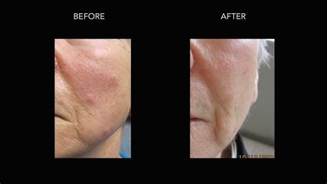 Mole Removal: Before & After Photos | DermMedica