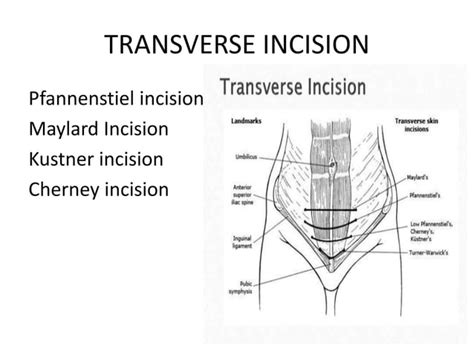 Abdominal incisions