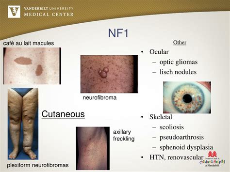 PPT - Neurocutaneous Disorders PowerPoint Presentation, free download - ID:4501574