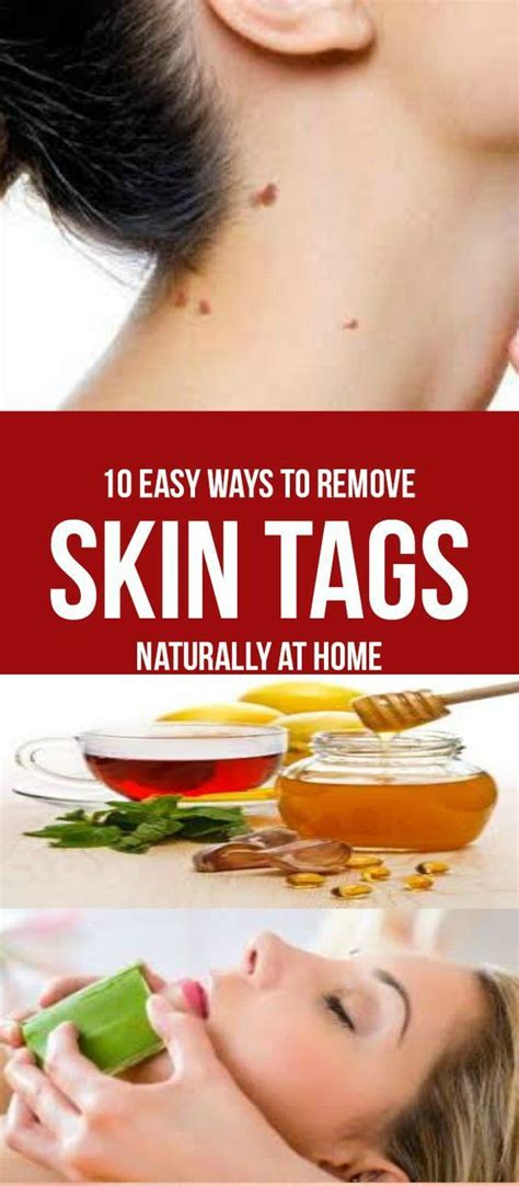 Home Remedies for Skin Tag Removal | Skin tags home remedies, Home remedies for skin, Remove ...