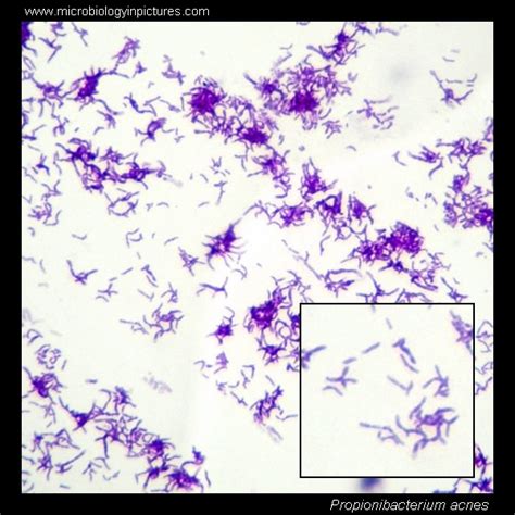 Propionibacterium acnes. Propionibacterium acnes Gram-stain and cell ...