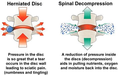 3 Benefits of Spinal Decompression: Active Health: Chiropractic ...