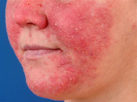 rosacea picture - pictures, photos