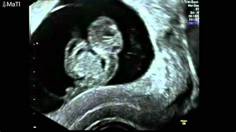 Ultrasound Twins 9 Weeks