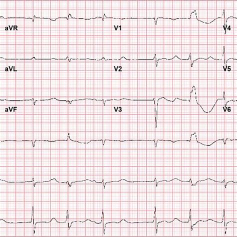 ECG on admission showing sinus rhythm with prolonged QT interval and... | Download Scientific ...