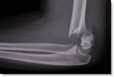 Classification of Supracondylar Humerus Fractures in Children – PEMBlog