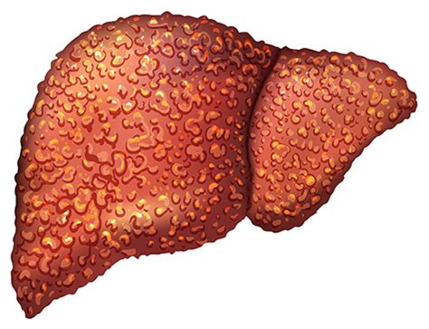 Cirrhosis: Understanding One of the Greatest Threats to Your Liver - University Health News