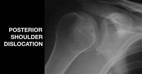 Posterior Shoulder Dislocation • LITFL • Trauma Library