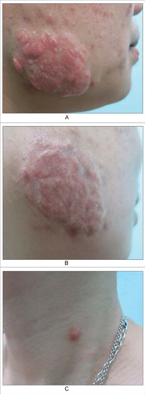 A keloid after acne in cheek. A. Before; B. After six months of... | Download Scientific Diagram