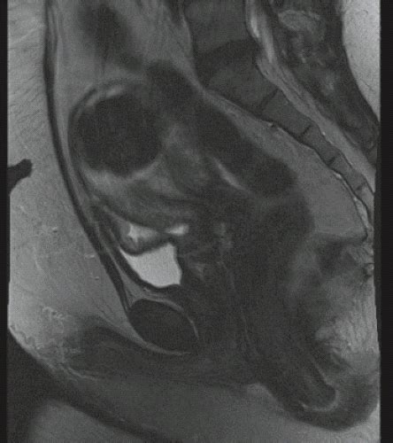 Hysteroscopic Myomectomy and Polypectomy, and Removal of Retained Products of Conception | Obgyn Key