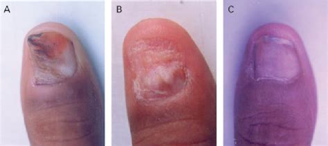 Figure 2 from En Bloc Excision of Proximal Nail Fold for Treatment of ...