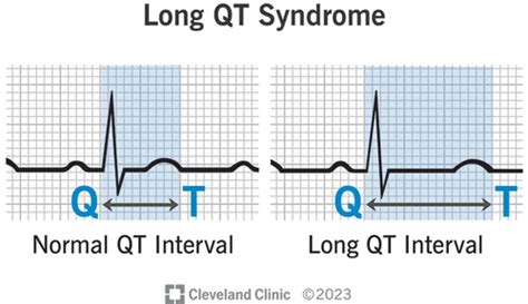 Long QT Syndrome Flashcards | Quizlet