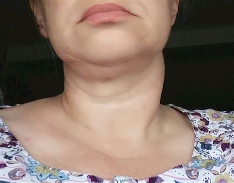 Swollen neck and thyroid nodule.. - Thyroid UK | HealthUnlocked