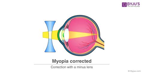 Myopia Causes, Symptoms, Formula And Nearsightedness