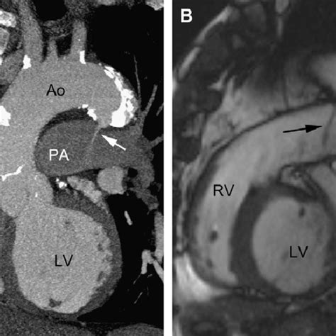 Dextro-transposition of the great arteries. (A) Axial CT image shows ...