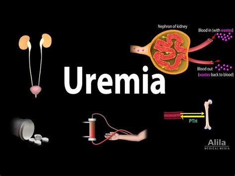 10 Symptoms of uremia You Should Never Ignore - Huffington News