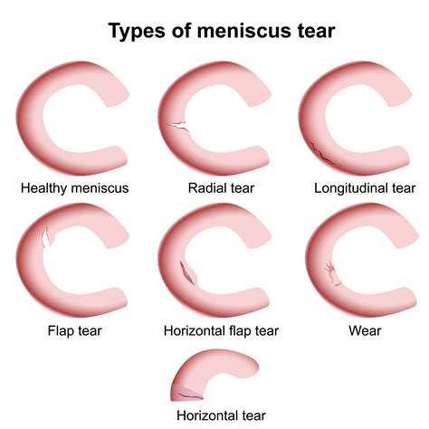 Meniscal Tear Types - JOI Jacksonville Orthopaedic Institute