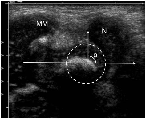 A four-year clinical and sonographic longitudinal follow-up of clubfeet ...
