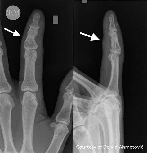 Middle Phalanx Fracture