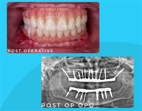 Basal Implants Cost in Mumbai-Dental Implant Kit-Types of Basal Implants