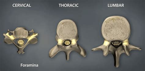 Foraminal Stenosis - Symptoms & Treatments | Florida Surgery