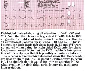 Recognition and Treatment of Right Ventricular Myocardial Infarction