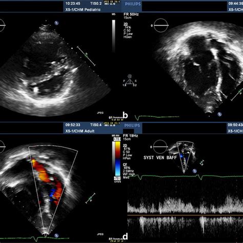 A 21-year-old male with D-TGA status post arterial switch surgery. High... | Download Scientific ...