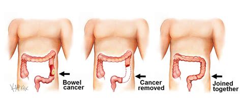 Bowel Surgery | Colorectal Surgeons Sydney