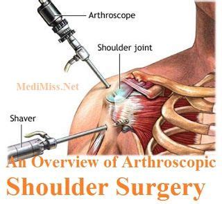 Shoulder Arthritis Surgery is an insignificantly obtrusive orthopedic surgical… | Arthroscopic ...