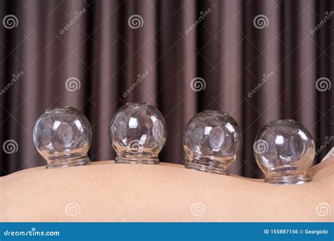 Woman Receiving Cupping Treatment on Back Stock Photo - Image of ...