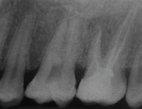 (a) The pretreatment radiograph showed an apical radiolucency on the... | Download Scientific ...