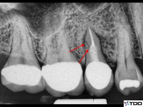 Saving More Teeth! The Periodontic-Endodontic InfectionTri-City Dev