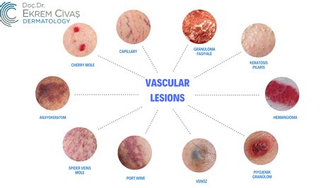 Vascular Lesions | Doç.Dr. Ekrem Civas - Dermatology