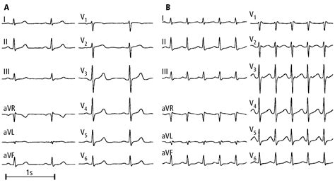 Figure 031_7423. Electrocardiography (ECG) of a patient with paroxysmal atrioventricular nodal ...