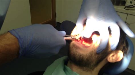 Tooth being pulled out by dentist -Very Graphic SFW - YouTube