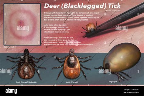 Illustration showing a deer tick bite and its removal Stock Photo - Alamy