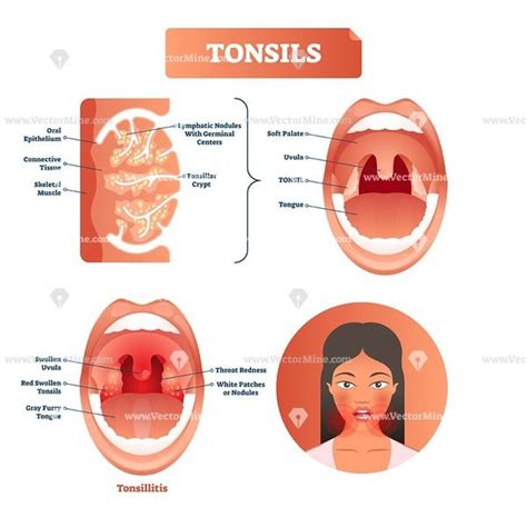 Tonsils anatomical vector illustration diagram | Vector illustration ...