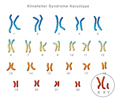 Klinefelters Syndrome Karyotype Acheter Une Photo | The Best Porn Website