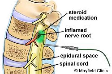 Translaminar injection #PsoasExercises in 2020