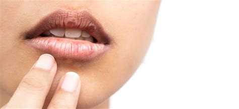 Dry Mouth Syndrome | Symptoms, Causes & Treatments