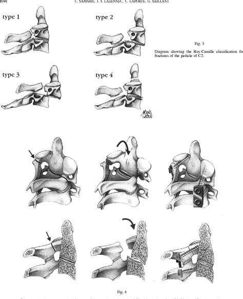 Figure 3 from Hangman's fracture: the relationship between asymmetry and instability. | Semantic ...