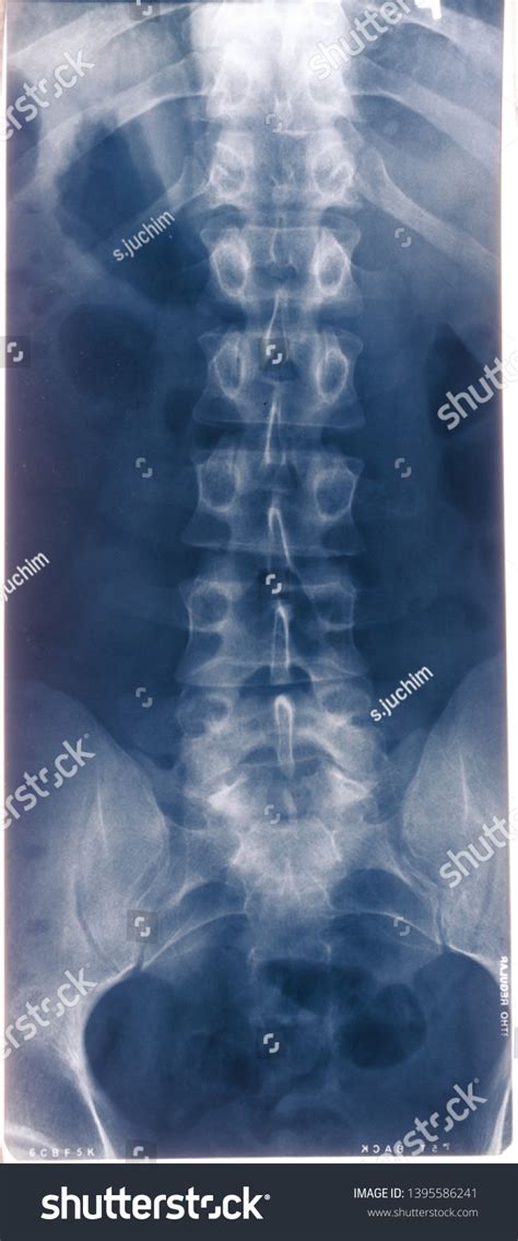 Human Back Bone Xray Examination Photo Stock Photo 1395586241 | Shutterstock